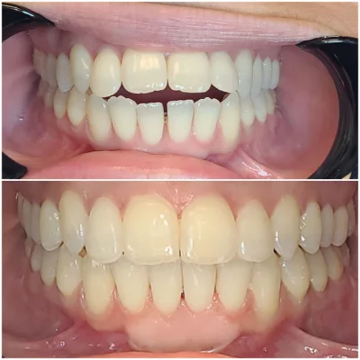 before_after_teeth